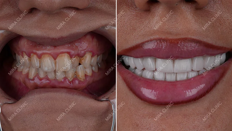 Saida Laabidi's Hollywood Smile Before and After